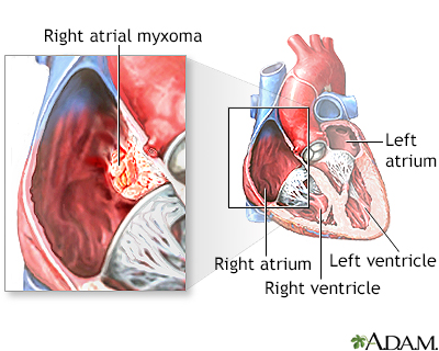 Right atrial myxoma