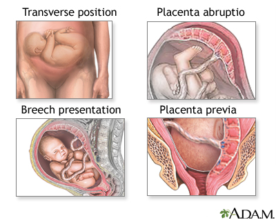 Different types of fetal presentation