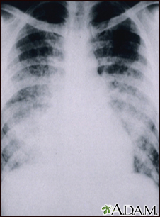 Chickenpox, acute pneumonia - chest X-ray