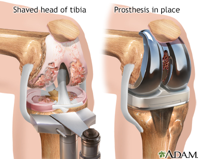 moving patella