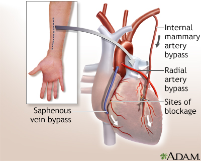 Heart bypass surgery cabg diagram 