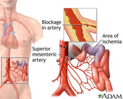 Mesenteric artery ischemia and infarction