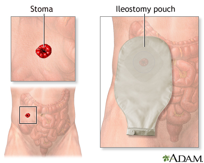Ileostomy - stoma and pouch