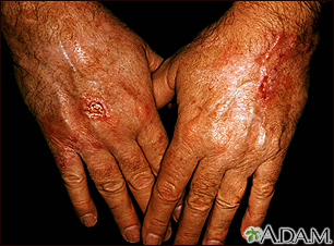 Skin cancer - squamous cell on the hands