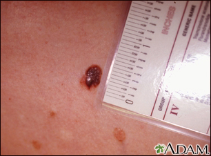 Skin cancer - close-up of level III melanoma