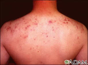 Acne - cystic on the back
