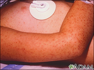 Rocky mountain spotted fever - petechial rash
