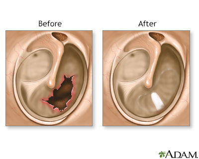 What are the symptoms of a burst eardrum?