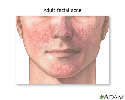 Adult facial acne