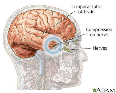 Brain hernia