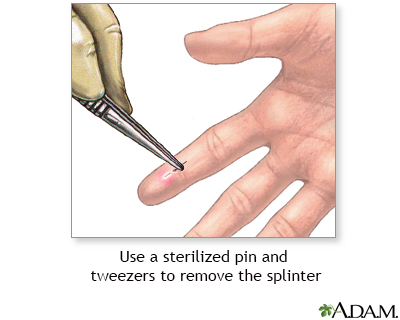 Splinter removal