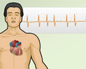 Cardiac arrhythmia symptoms